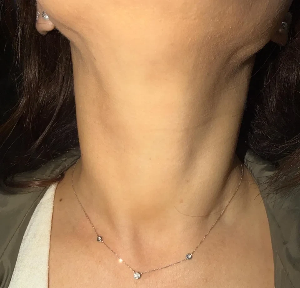 El mismo cuello cinco meses después de la ablación